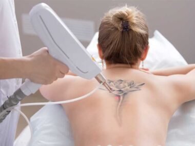 Everything You Need to Know About Tattoo Removal Techniques