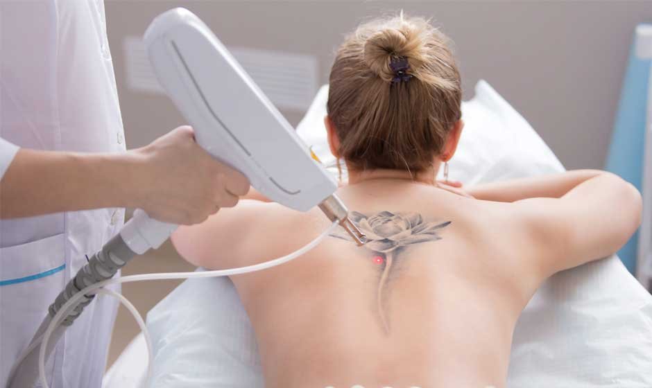Everything You Need to Know About Tattoo Removal Techniques