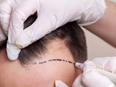 What Makes Sapphire the Next Level in Hair Restoration?