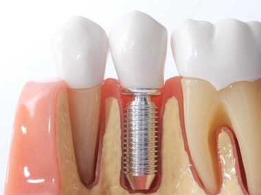 What to Consider When Getting Dental Implants