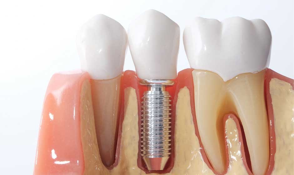 What to Consider When Getting Dental Implants