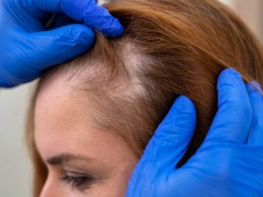 What Are the Benefits of a Female Hair Transplant?
