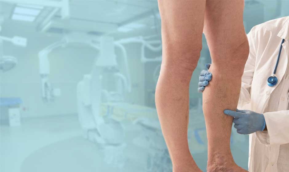 The 3 Best Ways To Get Rid Of Varicose Veins