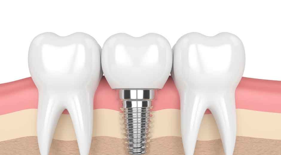 Everything You Need to Know Before Getting Dental Implants