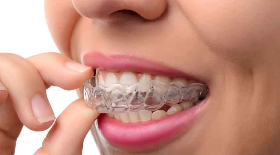How Same Day Orthodontic Treatment Is Changing Smiles in Surrey