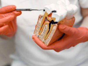 How Root Canal Therapy Saves Your Natural Teeth Effectively