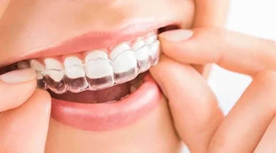 The Invisible Way to Get the Smile You've Always Wanted