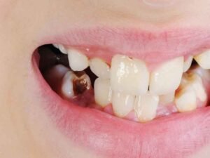 Why Early Childhood Tooth Decay Requires Expert Attention for Optimal Outcomes