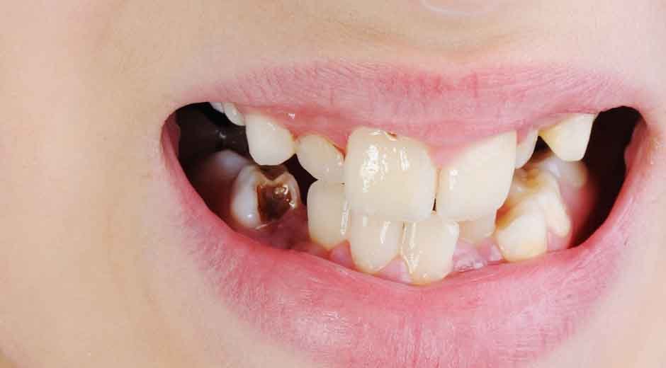Why Early Childhood Tooth Decay Requires Expert Attention for Optimal Outcomes