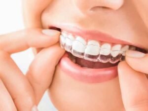 Discover How Effective Invisalign Truly Is With Expert Orthodontists in Kelowna