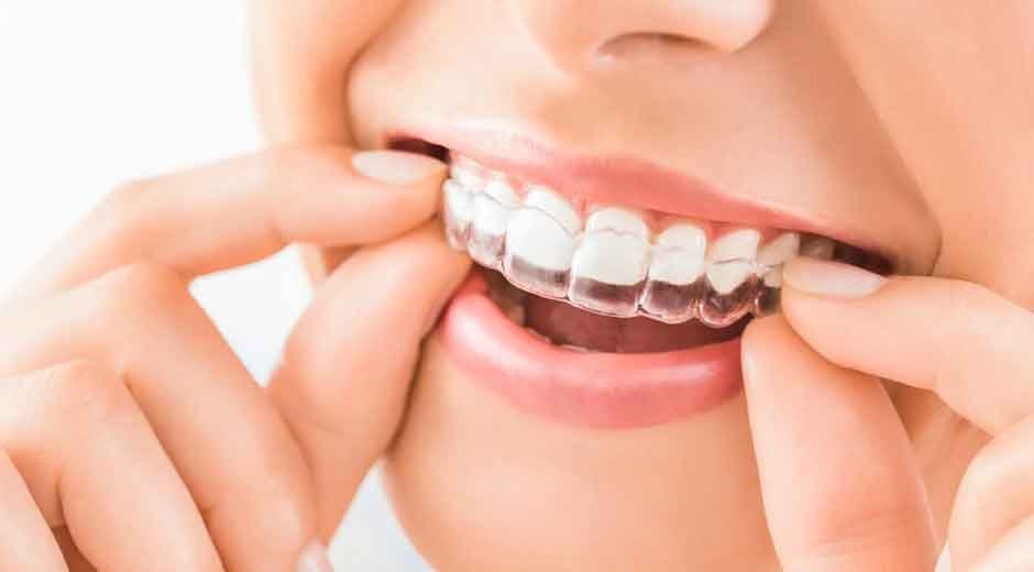 Discover How Effective Invisalign Truly Is With Expert Orthodontists in Kelowna