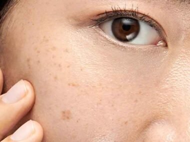 Why Some Dark Spots Fade Fast While Others Stick Around
