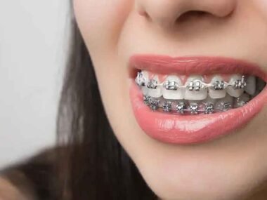 5 Reasons Patients in Surrey Pick Metal Braces