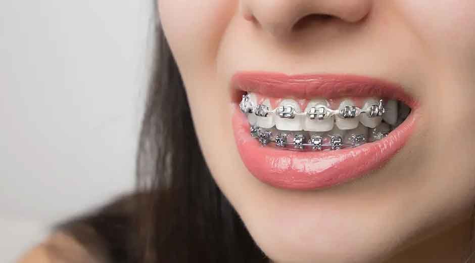 5 Reasons Patients in Surrey Pick Metal Braces