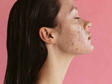 Acne Treatment: What You Can Control and What You Can't