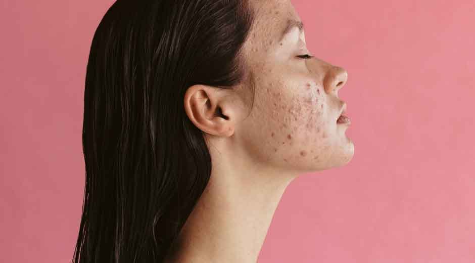 Acne Treatment: What You Can Control and What You Can't