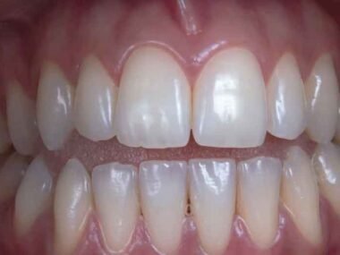 Guide to Fixing Your Smile for Dating Success