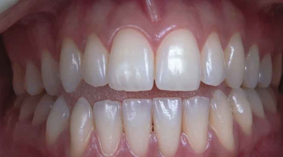 Guide to Fixing Your Smile for Dating Success