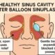 How-Balloon-Sinuplasty-Is-Transforming-Sinus-Health